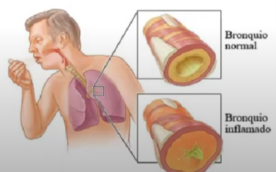 VENTILACION MECANICA